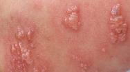 Clusters of herpes sores